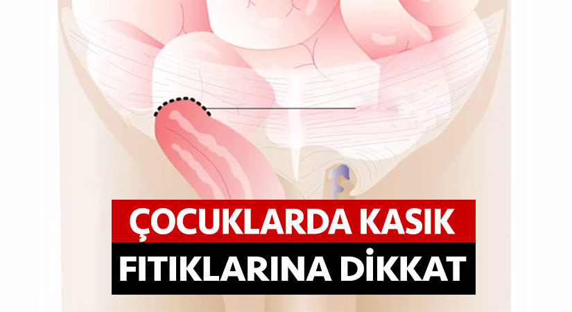 Çocuklarda kasık fıtıklarına dikkat